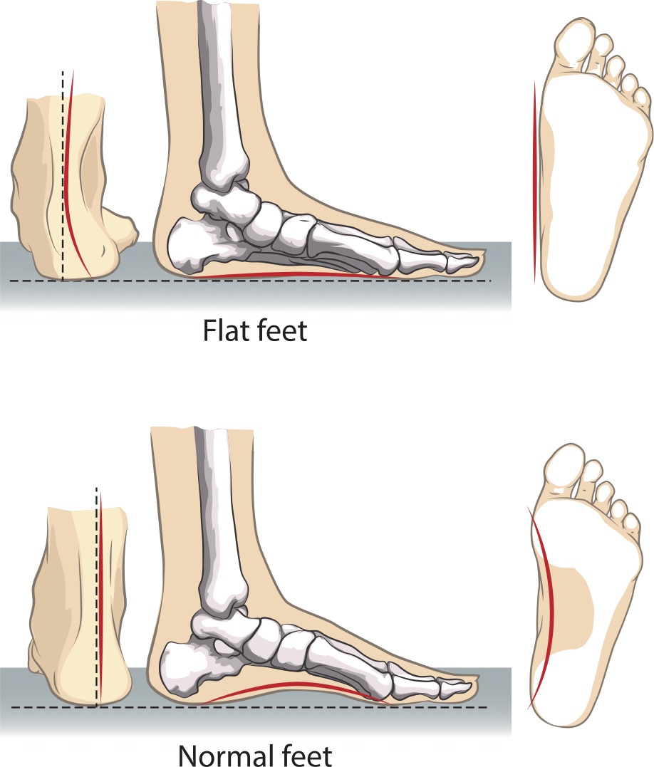 booties for flat feet